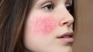 Žena s červenými skvrnami na tváři ukazuje kuperózní pleť.