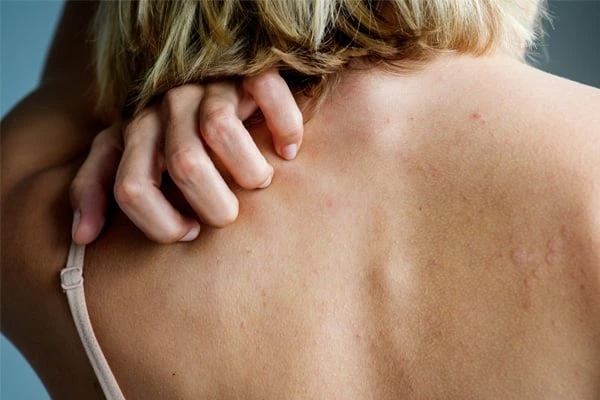 Žena škrábe svědění na svém zádech.