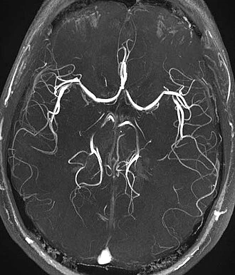 Angiografie mozku zobrazující cévy v bílé barvě na tmavém pozadí.