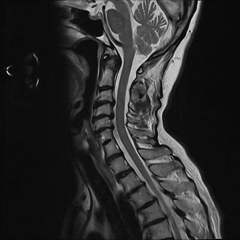Magnetická rezonance krční páteře pro diagnostiku brnění ruky.