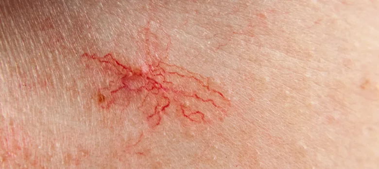 Zvětšený pohled na červené cévní rozšíření kůže.