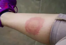 Červený kruhový flek na noze jako příznak boreliózy.