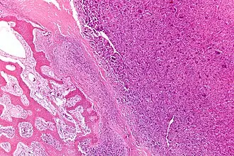 Histologický snímek kostního nádoru při mikroskopu