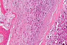 Osteosarcoma histology slide