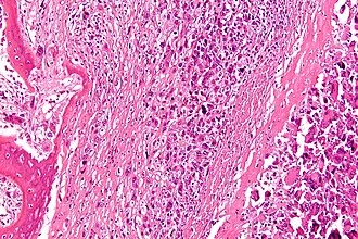 Osteosarcoma histology slide