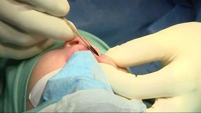 Palate cleft repair surgery